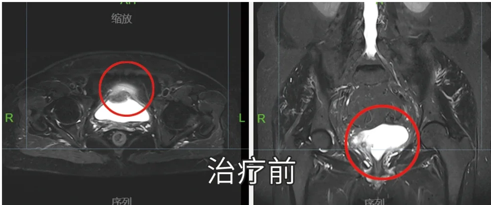 Pre-brachytherapy MR imaging of cervical cancer (official hospital material)