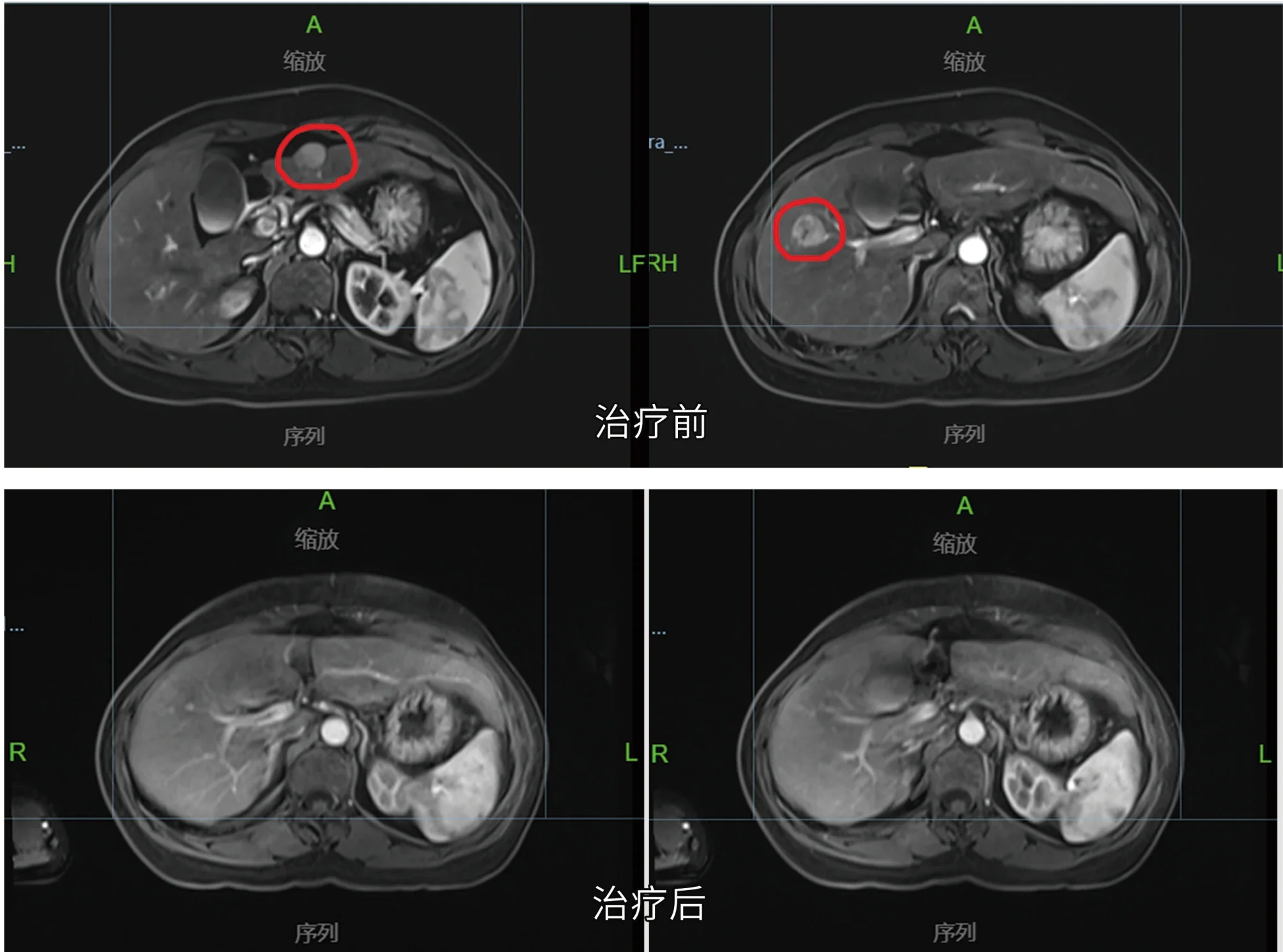 Pre- and post-treatment MR comparison of a liver cancer patient treated with CyberKnife (official hospital material)