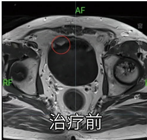 Pre-treatment MR imaging (official hospital material)