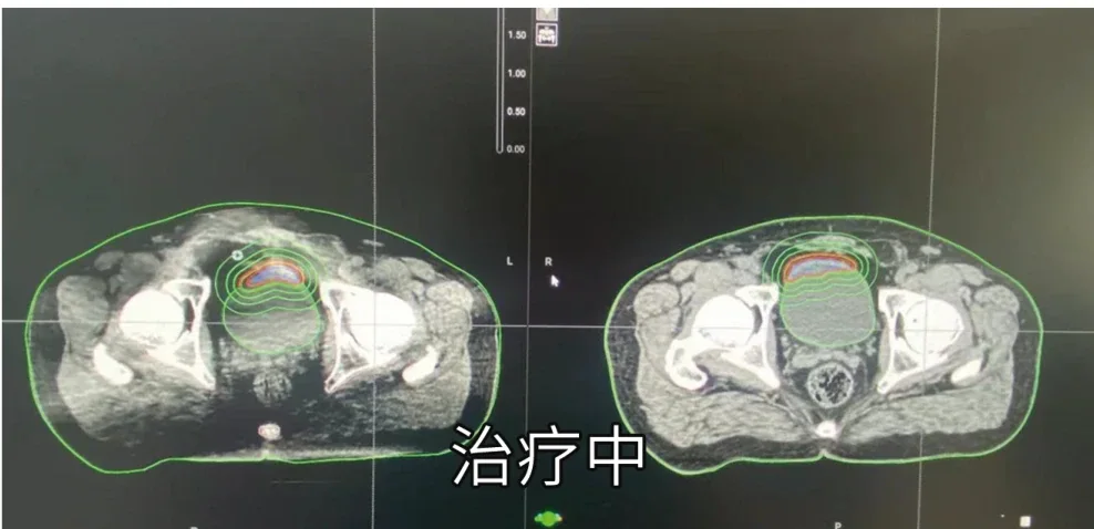 Target delineation imaging during Ethos adaptive radiotherapy (official hospital material)