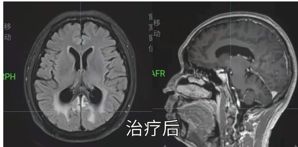 Post-radiotherapy imaging of intracranial lymphoma (official hospital material)