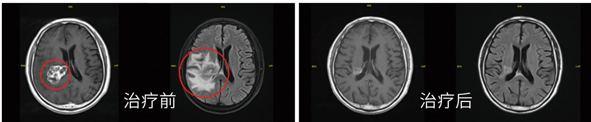 Pre- and post-radiotherapy imaging comparison of an intracranial tumor (official hospital material)