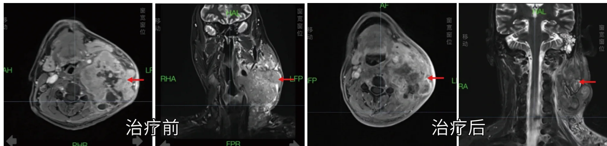 Pre- and post-radiotherapy imaging comparison of a head and neck tumor (official hospital material)